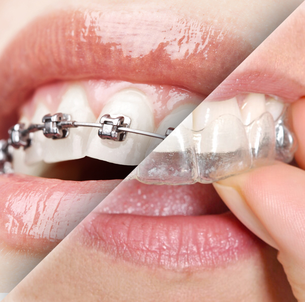 Invisalign vs. Braces
