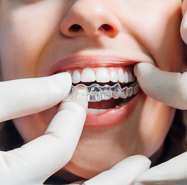 The Benefits of Invisalign