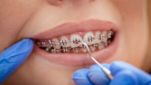 pink coloured braces